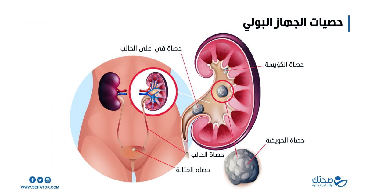 لماذا تزداد حصى الكلى في فصل الصيف وما طرق الوقاية؟