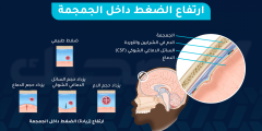 ارتفاع الضغط داخل الجمجمة: الأسباب والأعراض والعلاج