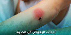 لماذا ينجذب البعوض لأشخاص أكثر من غيرهم؟