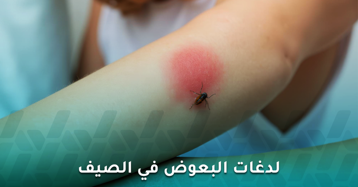 البعوض ينجذب لأشخاص أكثر من غيرهم فما التفسير؟