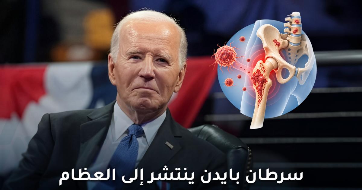 الحالة الصحية لجو بايدن: انتشار سرطان البروستاتا إلى العظام