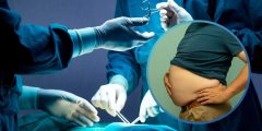 أدوية GLP-1 وتأثيرها على نتائج جراحات السمنة